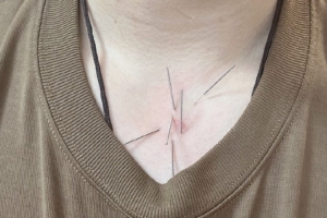 工作室晒赵继伟头&喉咙针灸图片：嗓子治疗进入下一阶段 加油💪